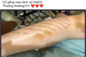 Trấn Thành x:ót x:a khi Hari Won bị ng:ã cầu thang cuốn, tình trạng hiện tại ra sao?