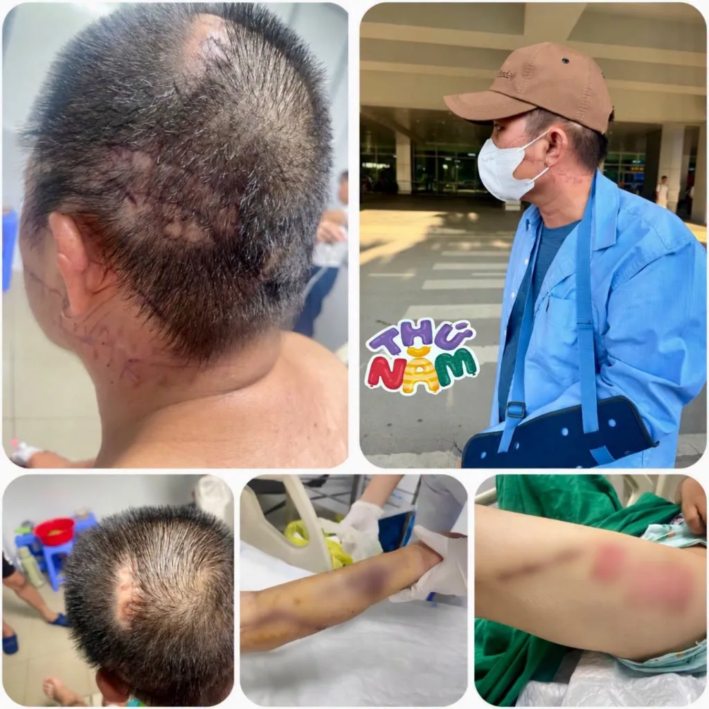 Tình trạng hiện tại của anh Quang, toàn bộ vết thương trên người xót xa vô cùng